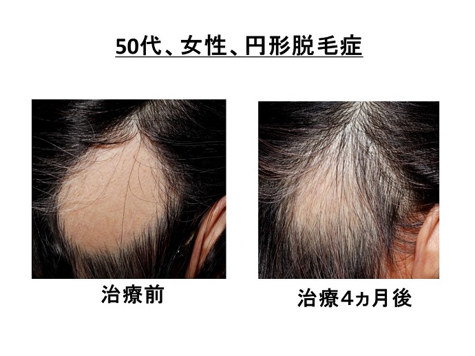 円形脱毛症　病院